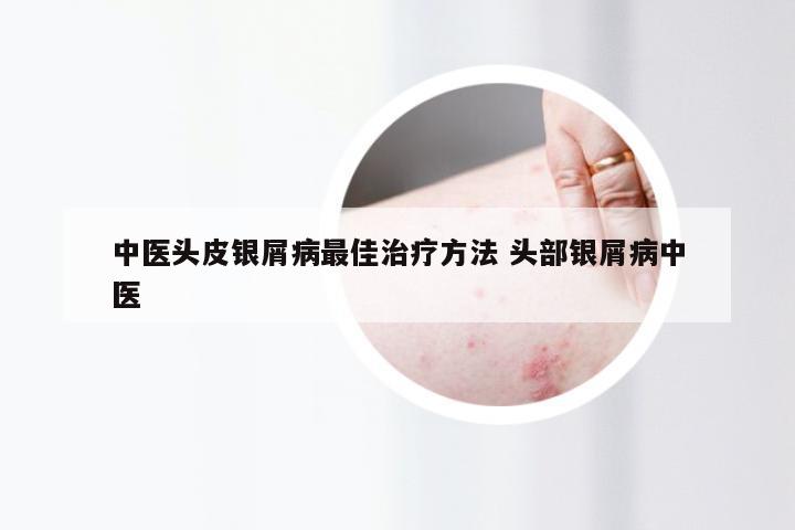 中医头皮银屑病最佳治疗方法 头部银屑病中医
