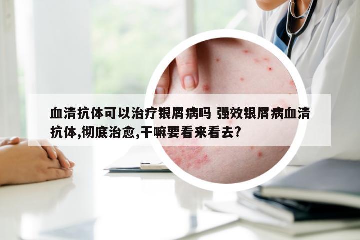 血清抗体可以治疗银屑病吗 强效银屑病血清抗体,彻底治愈,干嘛要看来看去?