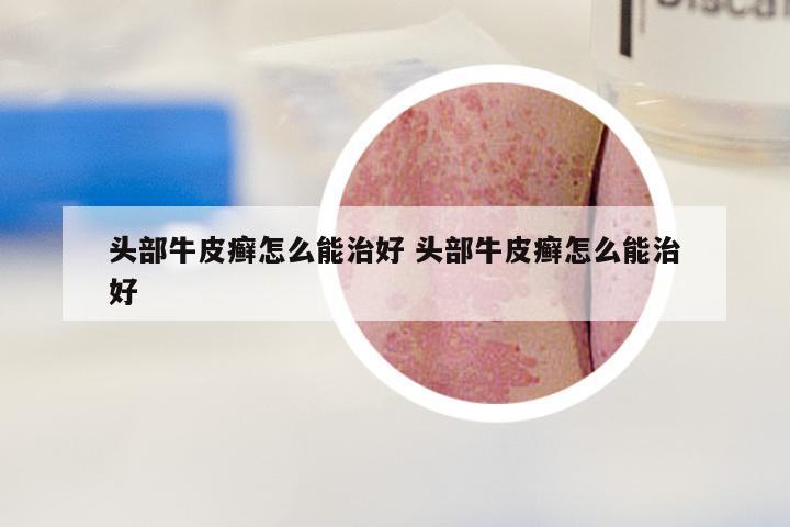 头部牛皮癣怎么能治好 头部牛皮癣怎么能治好