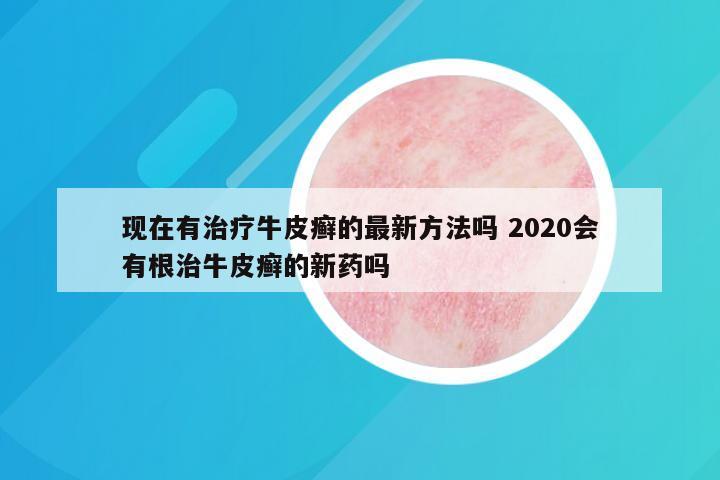 现在有治疗牛皮癣的最新方法吗 2020会有根治牛皮癣的新药吗