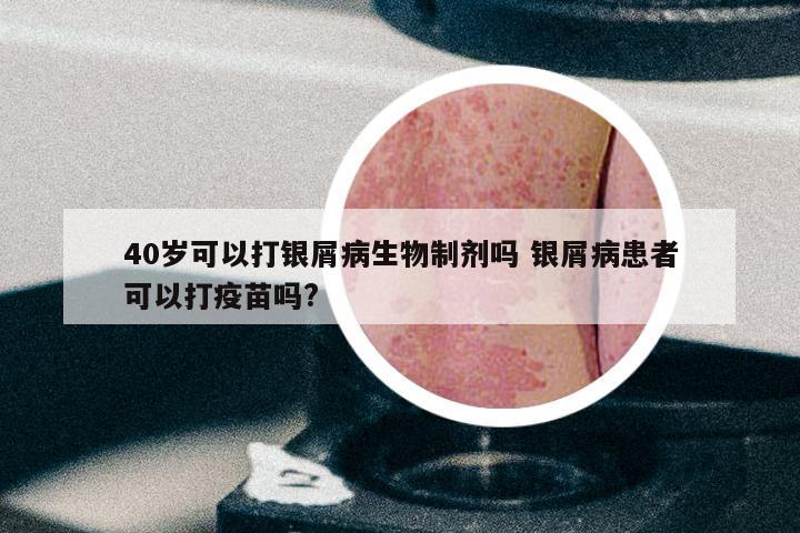 40岁可以打银屑病生物制剂吗 银屑病患者可以打疫苗吗?