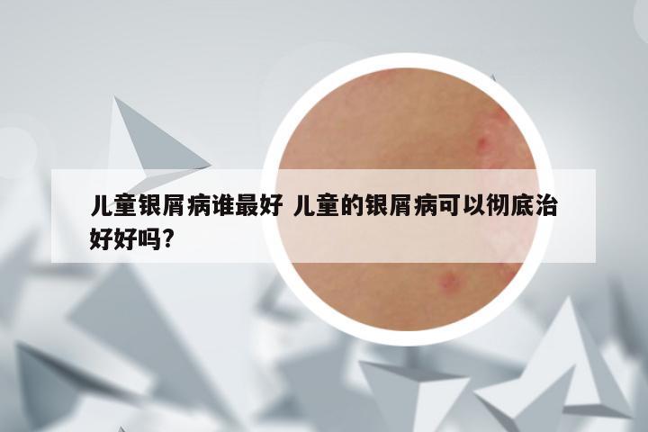 儿童银屑病谁最好 儿童的银屑病可以彻底治好好吗?