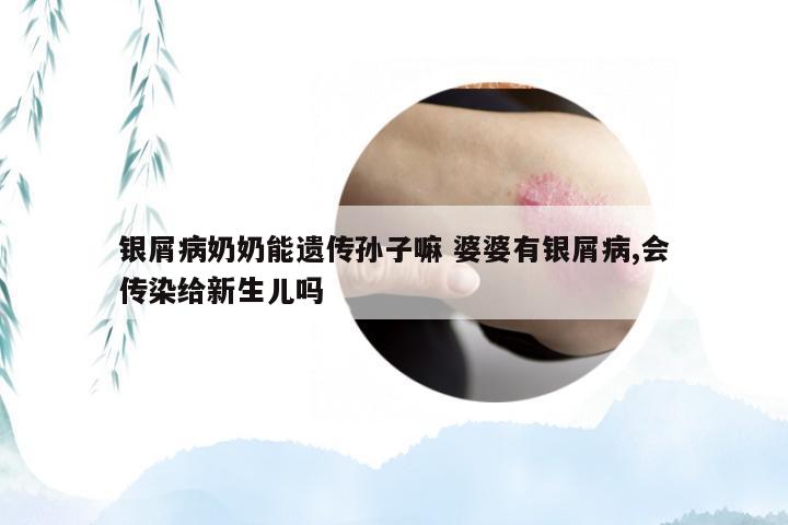 银屑病奶奶能遗传孙子嘛 婆婆有银屑病,会传染给新生儿吗