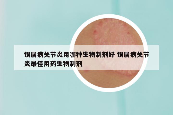 银屑病关节炎用哪种生物制剂好 银屑病关节炎最佳用药生物制剂