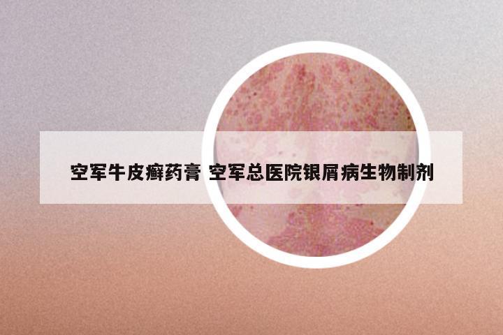 空军牛皮癣药膏 空军总医院银屑病生物制剂
