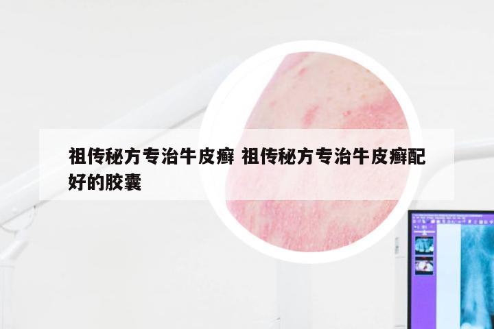 祖传秘方专治牛皮癣 祖传秘方专治牛皮癣配好的胶囊