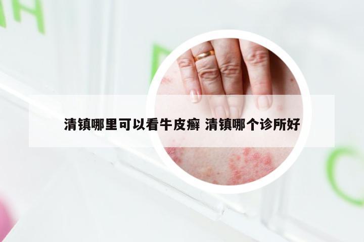 清镇哪里可以看牛皮癣 清镇哪个诊所好