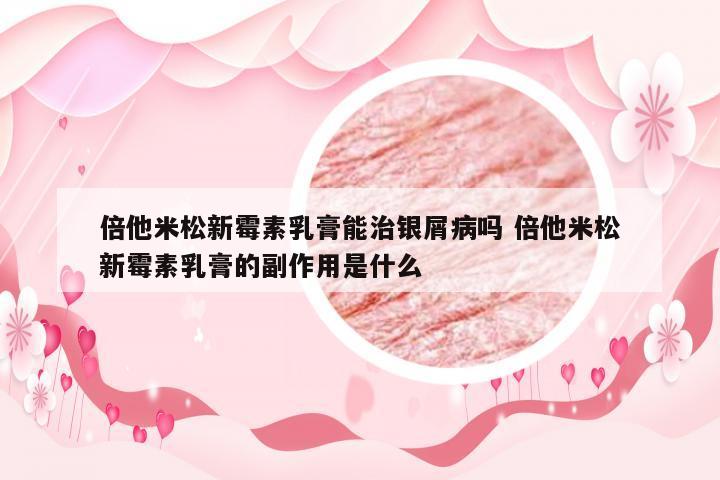 倍他米松新霉素乳膏能治银屑病吗 倍他米松新霉素乳膏的副作用是什么