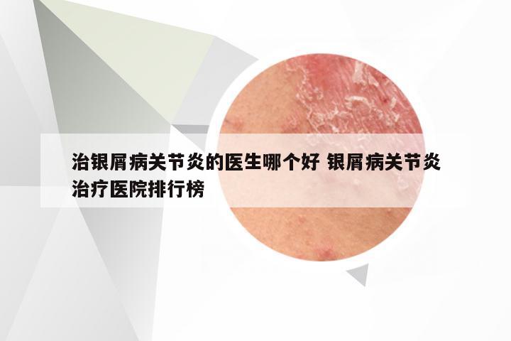 治银屑病关节炎的医生哪个好 银屑病关节炎治疗医院排行榜