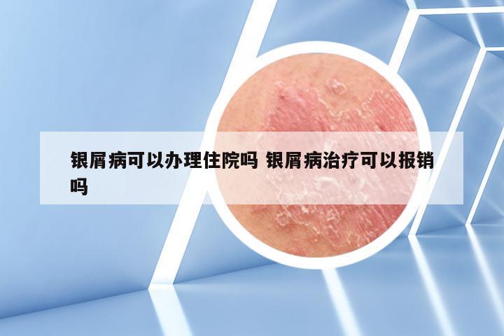 银屑病可以办理住院吗 银屑病治疗可以报销吗
