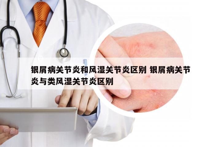 银屑病关节炎和风湿关节炎区别 银屑病关节炎与类风湿关节炎区别