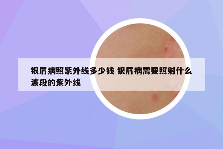 银屑病照紫外线多少钱 银屑病需要照射什么波段的紫外线
