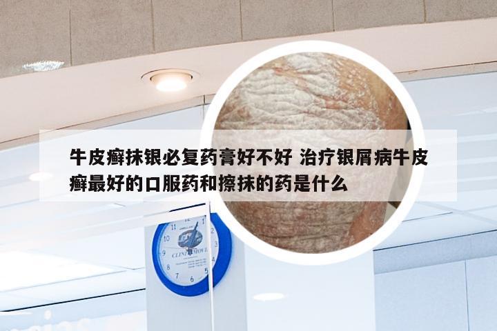 牛皮癣抹银必复药膏好不好 治疗银屑病牛皮癣最好的口服药和擦抹的药是什么
