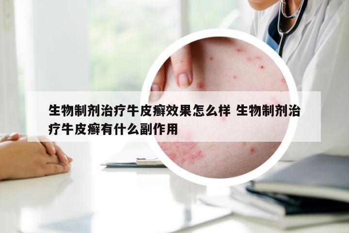 生物制剂治疗牛皮癣效果怎么样 生物制剂治疗牛皮癣有什么副作用