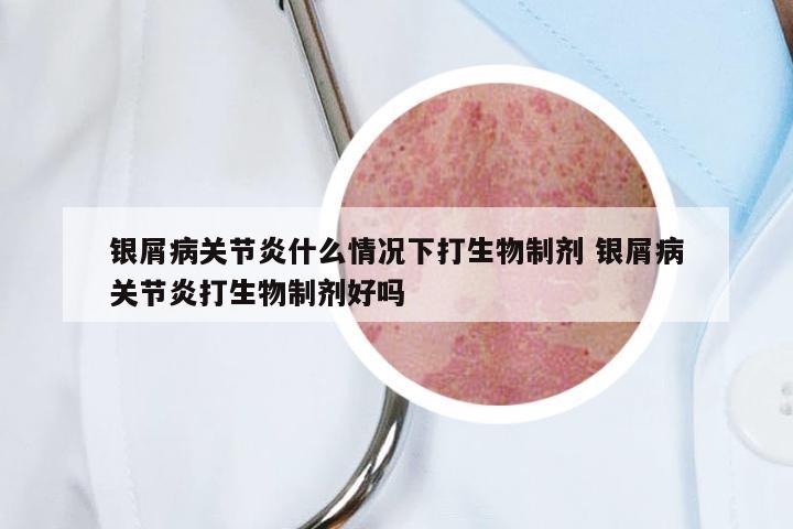 银屑病关节炎什么情况下打生物制剂 银屑病关节炎打生物制剂好吗