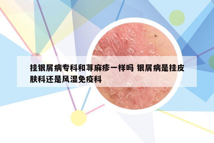 挂银屑病专科和荨麻疹一样吗 银屑病是挂皮肤科还是风湿免疫科