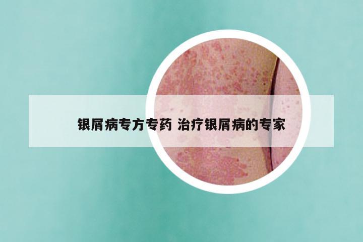 银屑病专方专药 治疗银屑病的专家