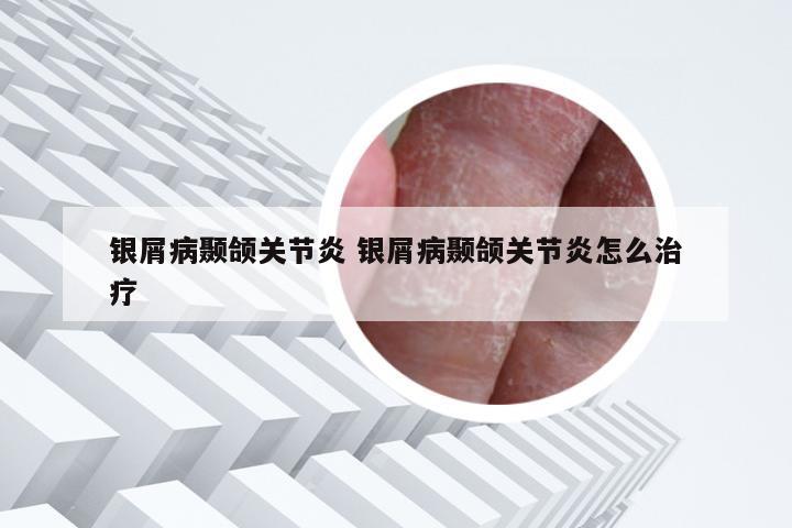 银屑病颞颌关节炎 银屑病颞颌关节炎怎么治疗