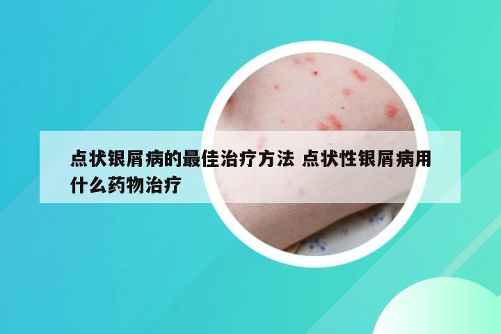 点状银屑病的最佳治疗方法 点状性银屑病用什么药物治疗