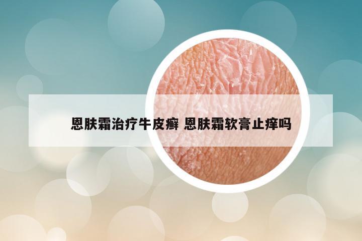 恩肤霜治疗牛皮癣 恩肤霜软膏止痒吗