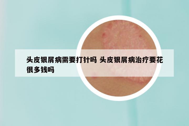 头皮银屑病需要打针吗 头皮银屑病治疗要花很多钱吗