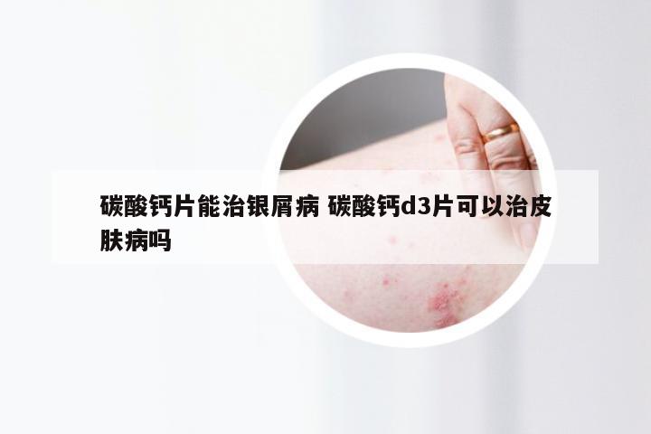 碳酸钙片能治银屑病 碳酸钙d3片可以治皮肤病吗