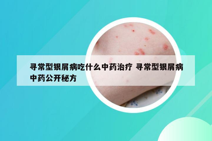 寻常型银屑病吃什么中药治疗 寻常型银屑病中药公开秘方