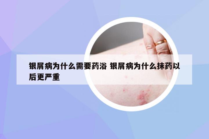 银屑病为什么需要药浴 银屑病为什么抹药以后更严重