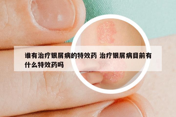 谁有治疗银屑病的特效药 治疗银屑病目前有什么特效药吗