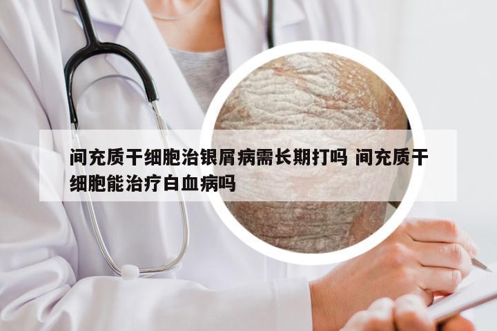 间充质干细胞治银屑病需长期打吗 间充质干细胞能治疗白血病吗