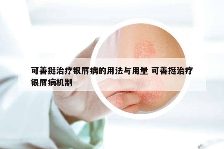 可善挺治疗银屑病的用法与用量 可善挺治疗银屑病机制