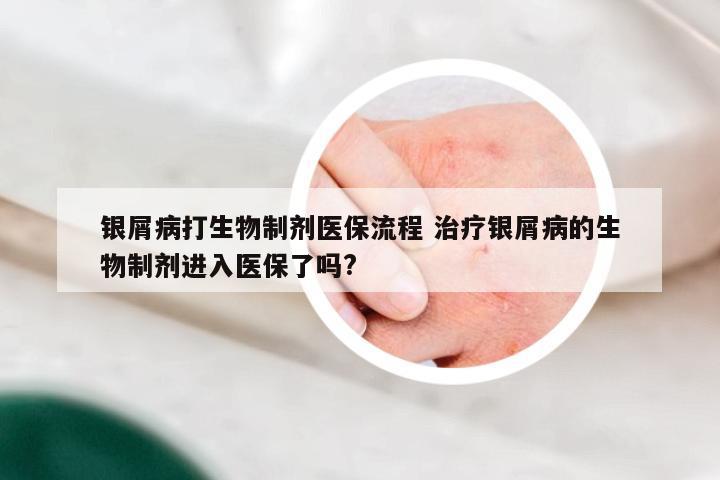 银屑病打生物制剂医保流程 治疗银屑病的生物制剂进入医保了吗?