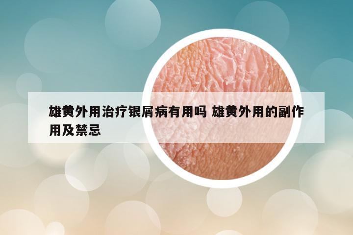 雄黄外用治疗银屑病有用吗 雄黄外用的副作用及禁忌