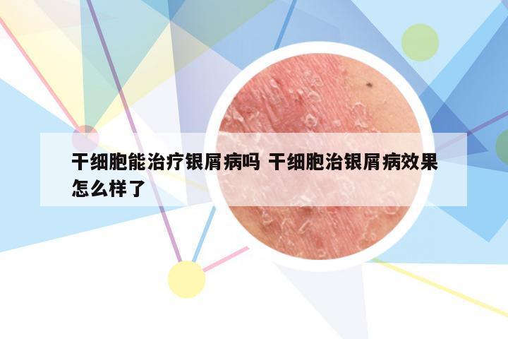 干细胞能治疗银屑病吗 干细胞治银屑病效果怎么样了