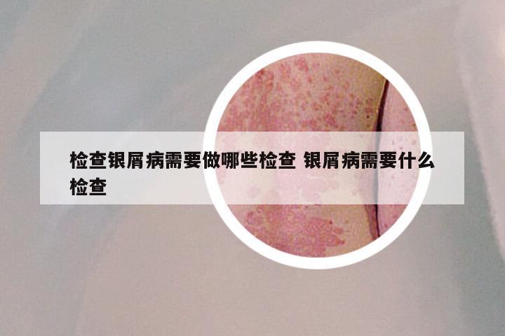 检查银屑病需要做哪些检查 银屑病需要什么检查