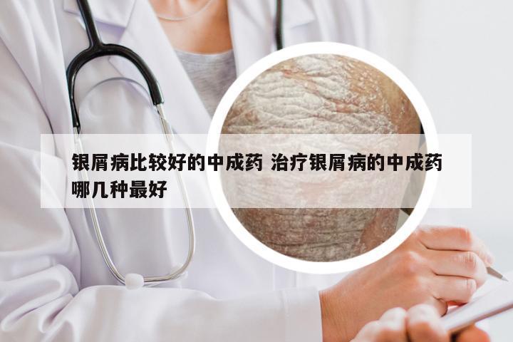 银屑病比较好的中成药 治疗银屑病的中成药哪几种最好