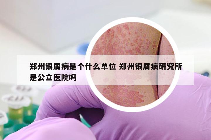 郑州银屑病是个什么单位 郑州银屑病研究所是公立医院吗