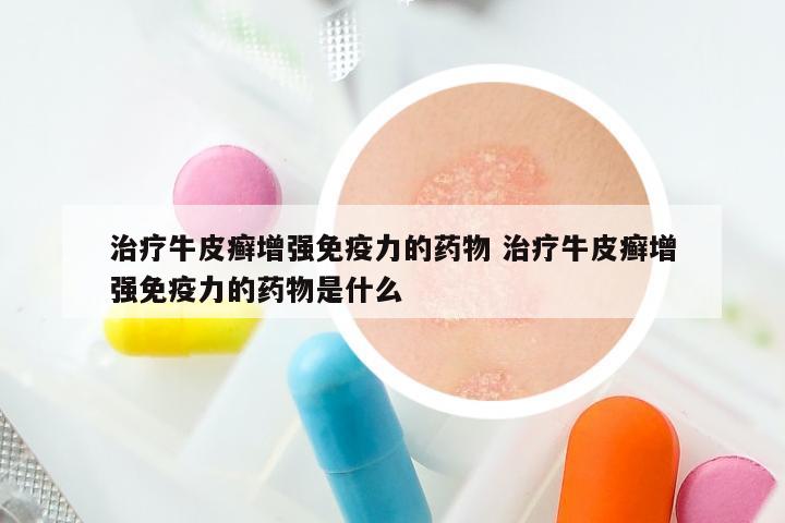 治疗牛皮癣增强免疫力的药物 治疗牛皮癣增强免疫力的药物是什么