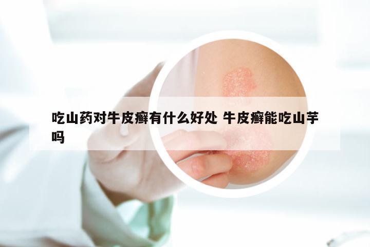 吃山药对牛皮癣有什么好处 牛皮癣能吃山芋吗