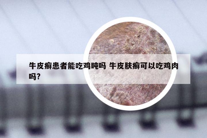 牛皮癣患者能吃鸡盹吗 牛皮肤癣可以吃鸡肉吗?