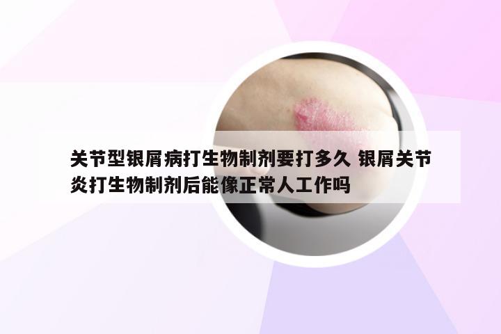 关节型银屑病打生物制剂要打多久 银屑关节炎打生物制剂后能像正常人工作吗