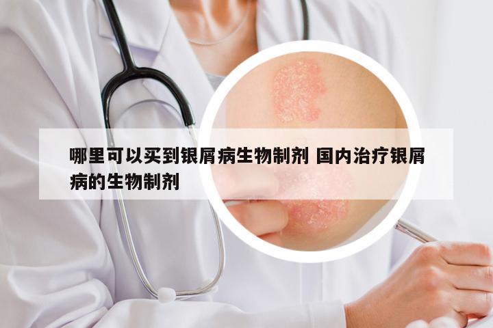哪里可以买到银屑病生物制剂 国内治疗银屑病的生物制剂