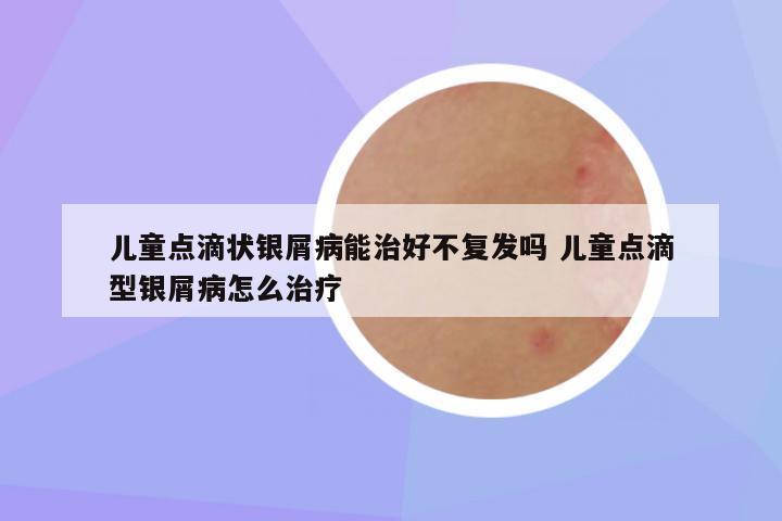 儿童点滴状银屑病能治好不复发吗 儿童点滴型银屑病怎么治疗