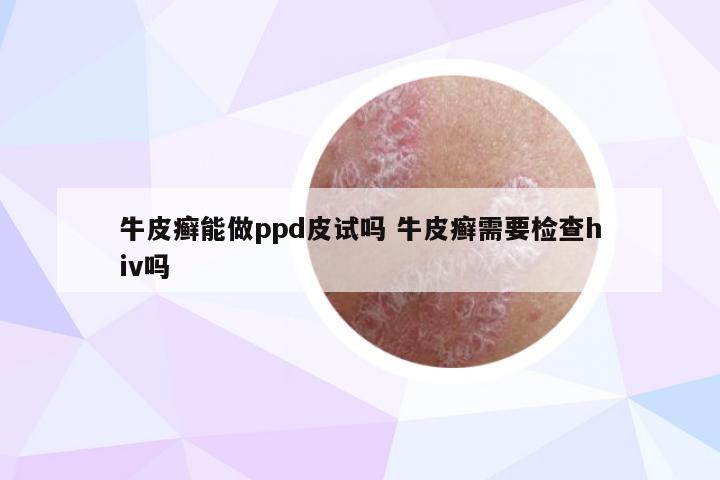 牛皮癣能做ppd皮试吗 牛皮癣需要检查hiv吗