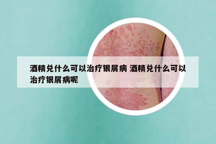 酒精兑什么可以治疗银屑病 酒精兑什么可以治疗银屑病呢