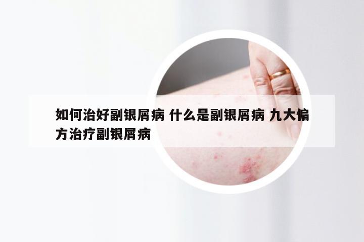 如何治好副银屑病 什么是副银屑病 九大偏方治疗副银屑病