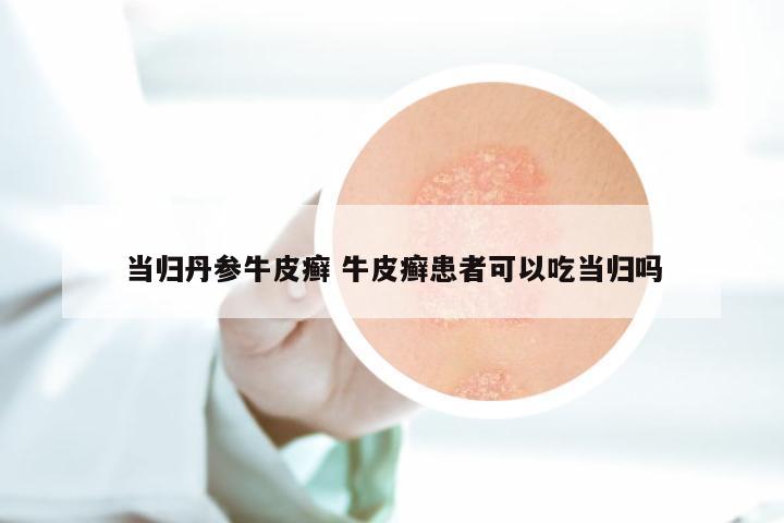 当归丹参牛皮癣 牛皮癣患者可以吃当归吗