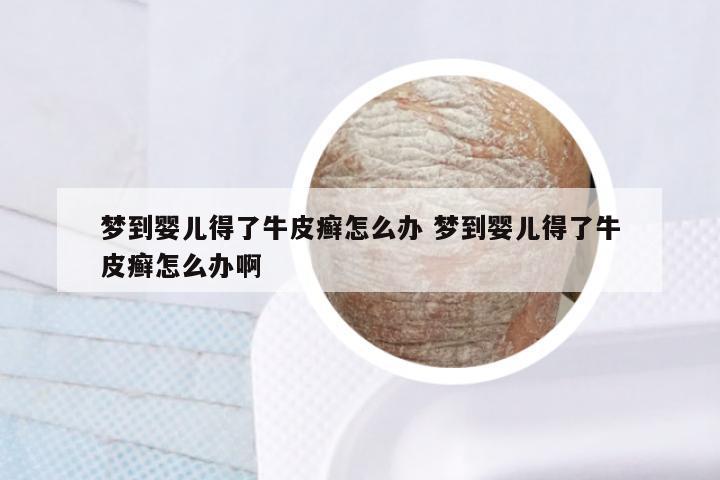 梦到婴儿得了牛皮癣怎么办 梦到婴儿得了牛皮癣怎么办啊