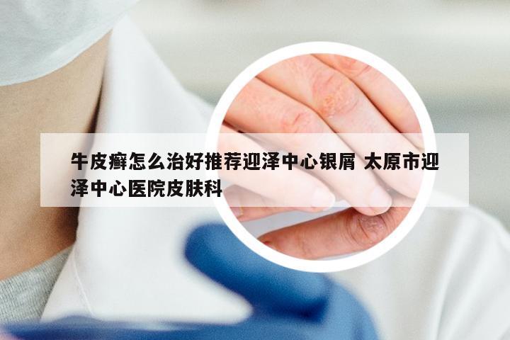 牛皮癣怎么治好推荐迎泽中心银屑 太原市迎泽中心医院皮肤科
