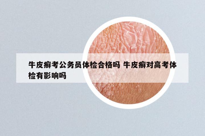 牛皮癣考公务员体检合格吗 牛皮癣对高考体检有影响吗